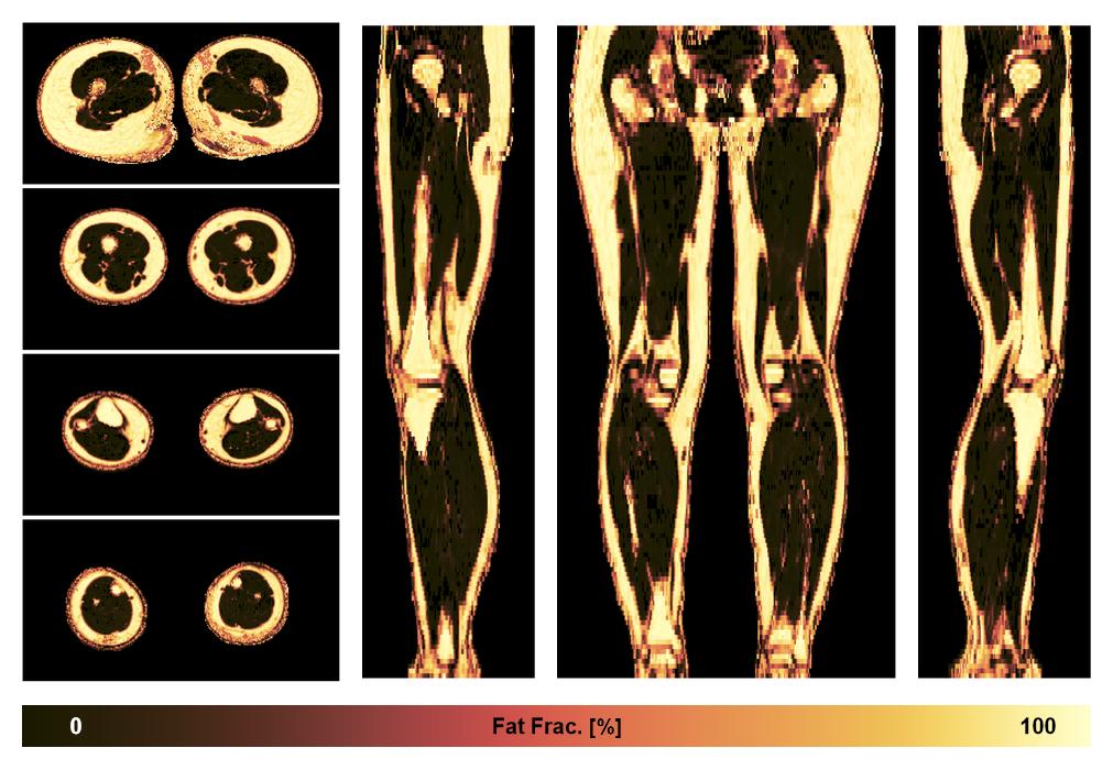 The fat fraction of the lower extremity obtained from the dixon reconstruction for muscle water fat quantification.